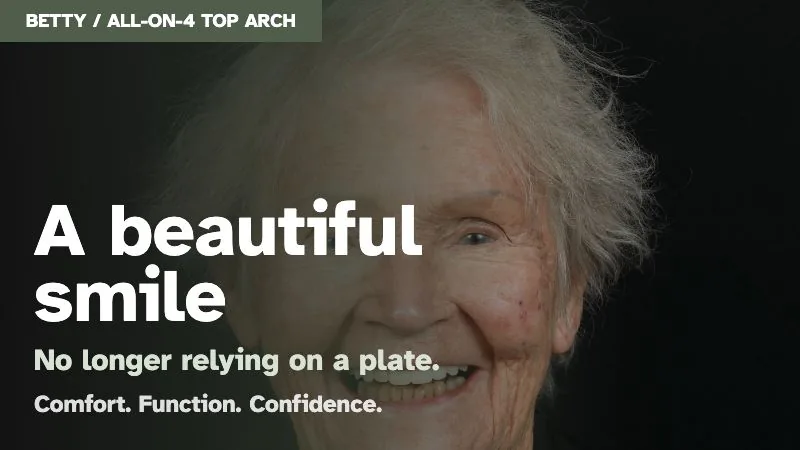 All-on-4 top arch real patient case thumbnail