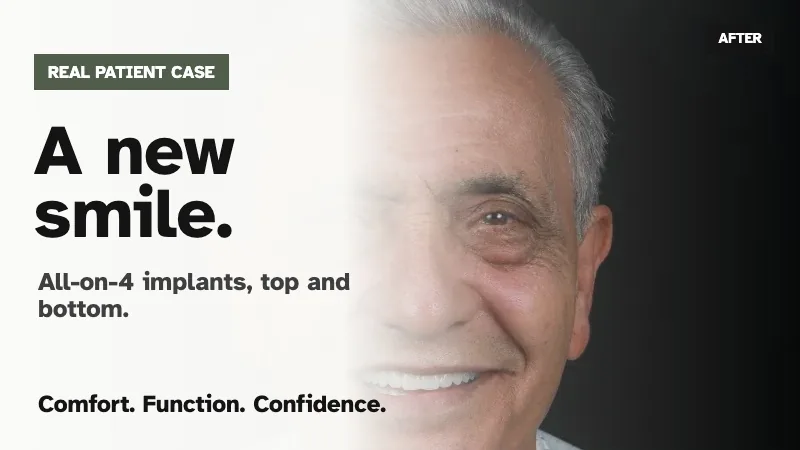 All-on-4 implants top and bottom real patient case thumbnail