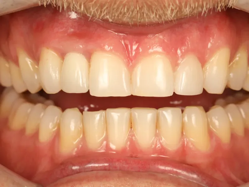 After single-tooth implant treatment