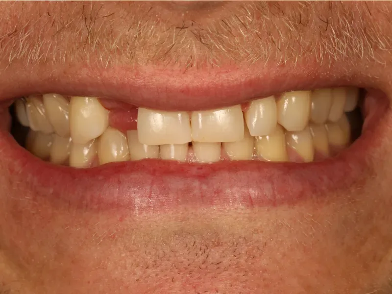 Before single-tooth implant treatment