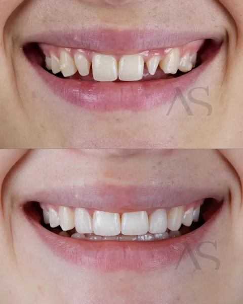 Peg laterals case by Dr Andrew See