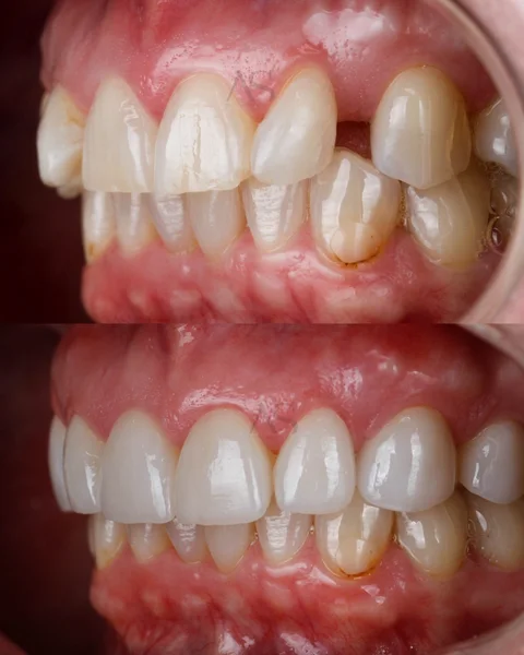 Porcelain veneers case by Dr Andrew See